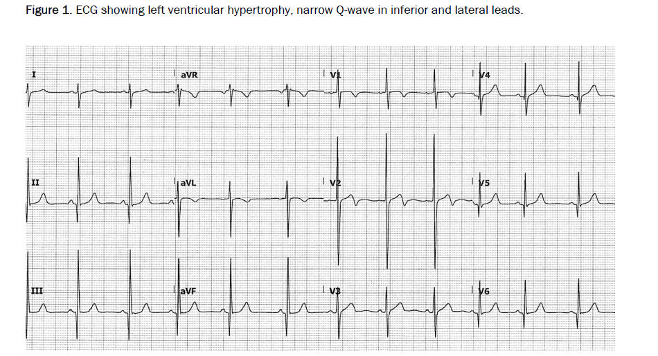 ventricular