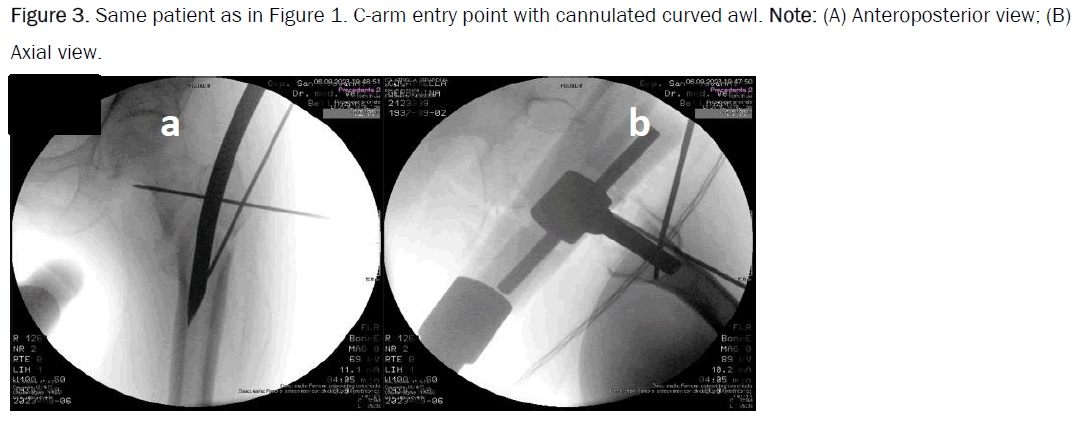 orthopedics-cannulated