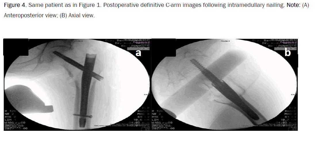 orthopedics-intramedullary