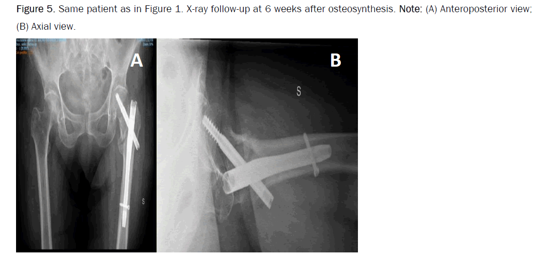 orthopedics-osteosynthesis