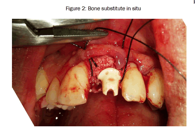 dental-sciences-Bone-substitute-situ