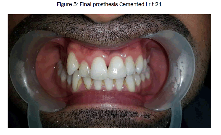 dental-sciences-Final-prosthesis-Cemented