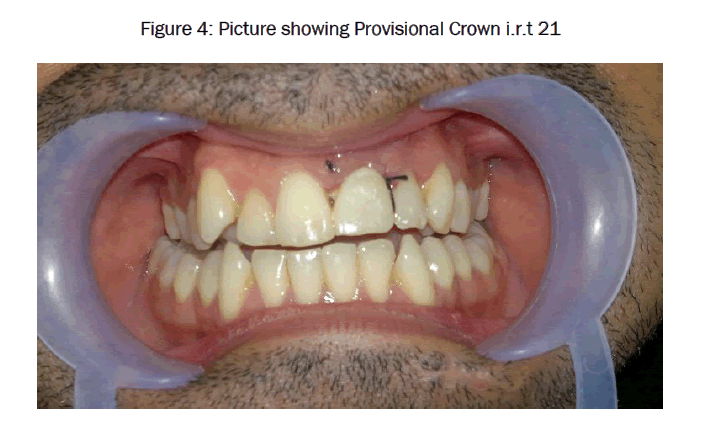 dental-sciences-Picture-showing-Provisional-Crown